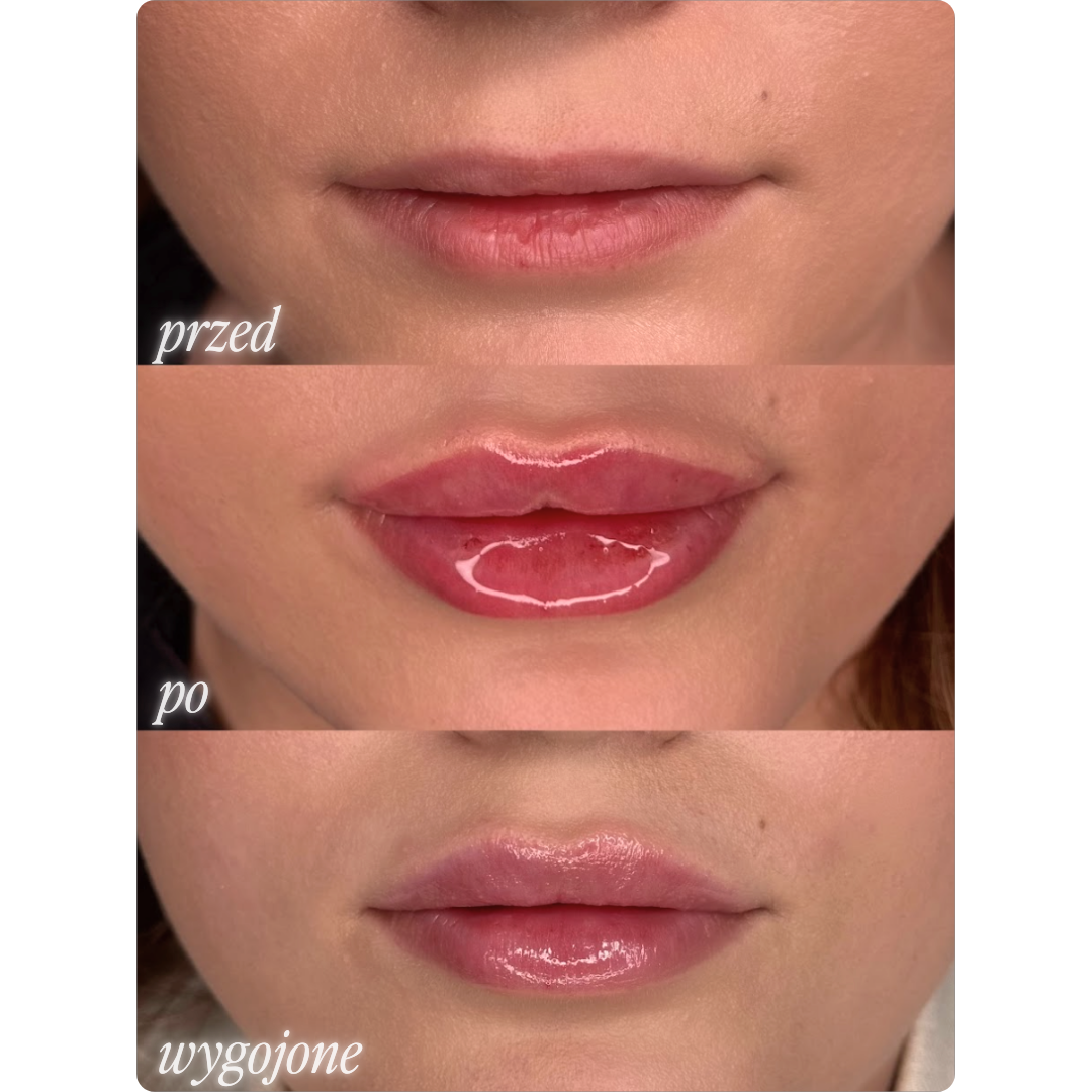 Modelowanie ust - efekty przed i po