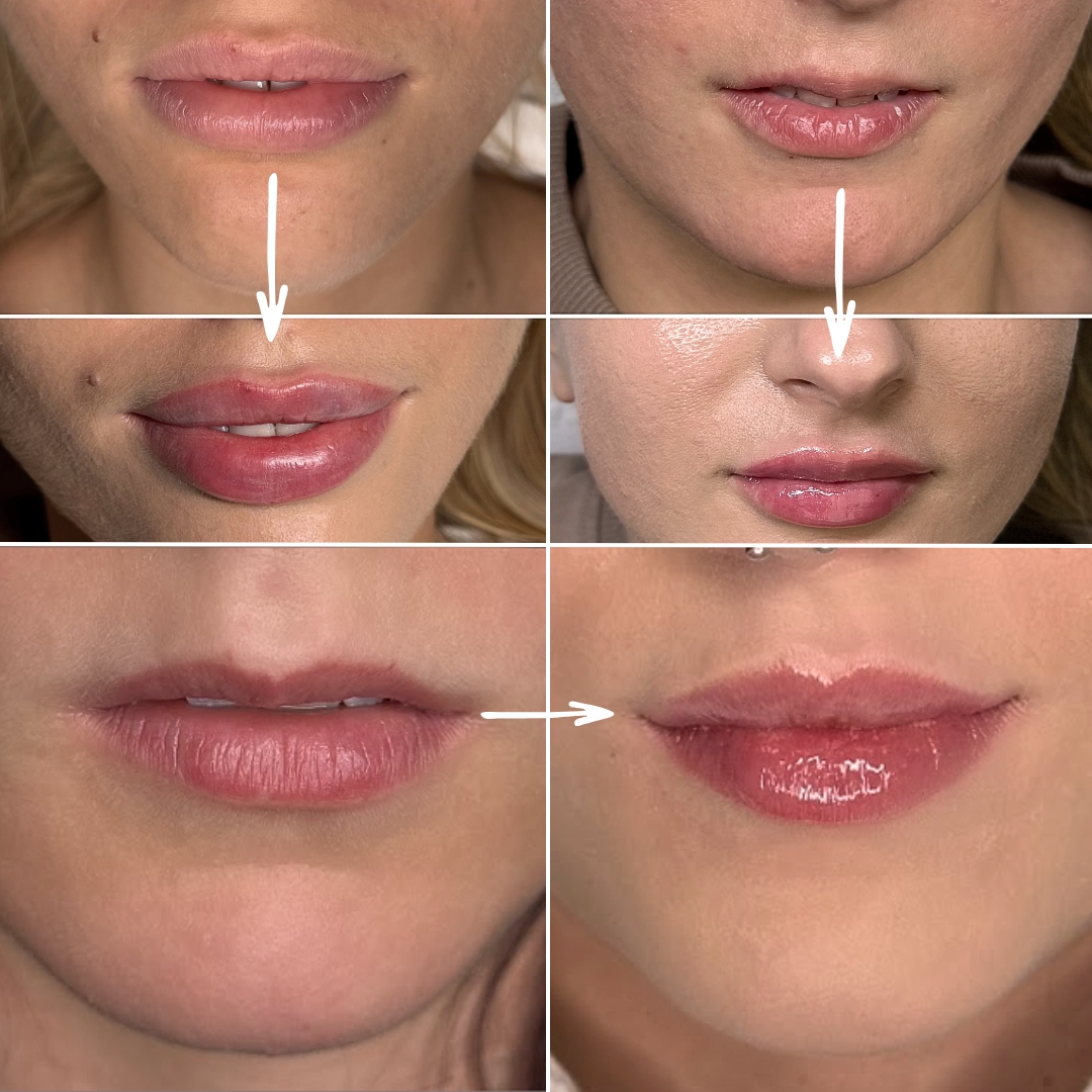 Proces modelowania ust - indywidualne podejście